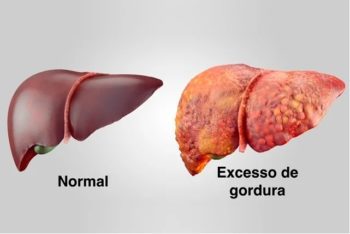 O que é bom para gordura no fígado? Veja como reverter!